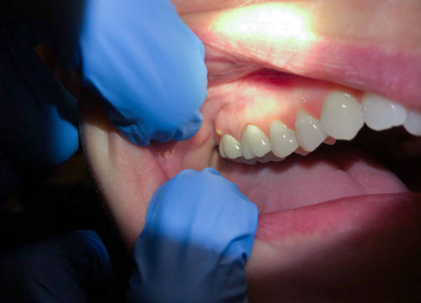 Best Emergency Dentist for Lost Fillings or Crowns in Salem, AR
